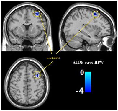 Cerebral Regional Homogeneity Alternation of Pregnant Women With Antenatal Depression During the Pandemic